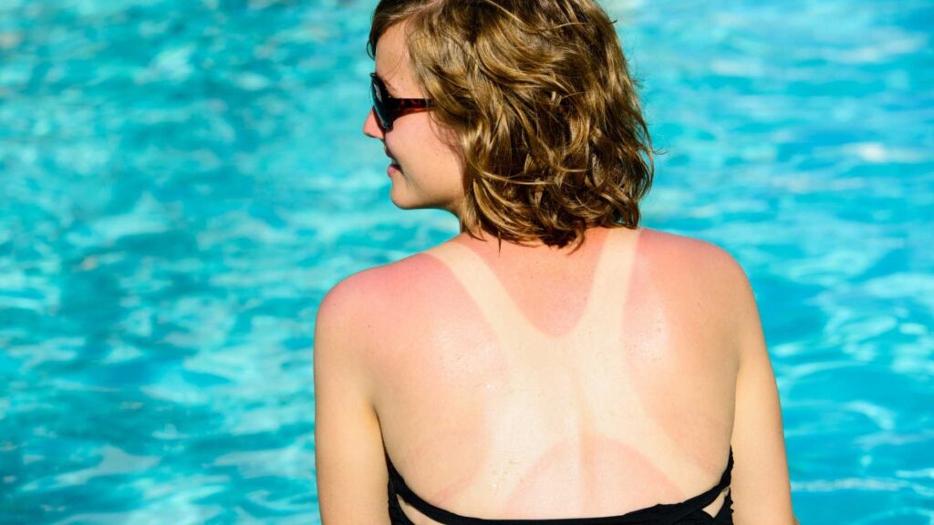 aceite cbd y quemaduras solares